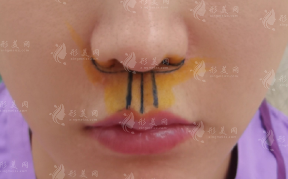 人中縮短術(shù)為什么不建議？除了手術(shù)還有別的辦法嗎？