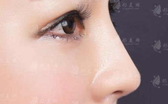 肋軟骨隆鼻可以用別人的嗎？會(huì)有什么區(qū)別嗎？
