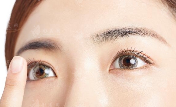 雙眼皮埋線般需要多少錢？做完能維持幾年？