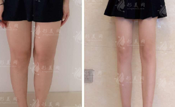 大腿抽脂后有硬塊正常嗎？多久會(huì)消失？
