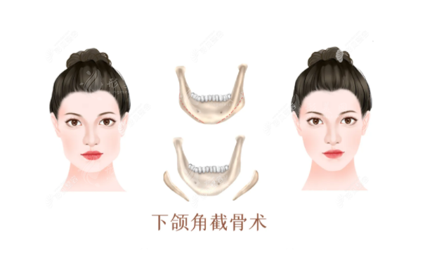 上海時光磨骨失敗修復(fù)的方式介紹