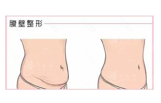 腹壁整形手術(shù)費(fèi)用多少？