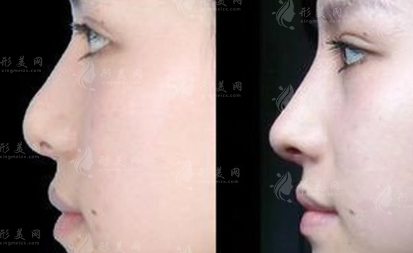假體隆鼻會(huì)變形嗎?我們?cè)撊绾伪苊鈤