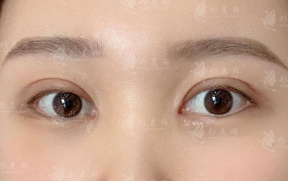 定點(diǎn)雙眼皮能維持幾年？手術(shù)效果美滋滋~
