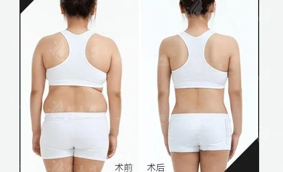 背部吸脂的手術(shù)方法及原理，瘦身效果真的好突出~