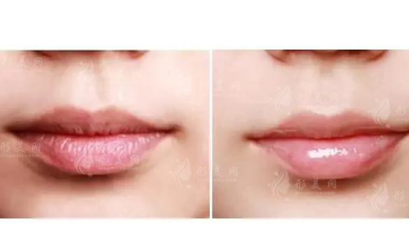 m唇手術(shù)步驟是怎么樣的?手術(shù)過(guò)程詳細(xì)分解~