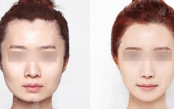 磨骨瘦臉效果怎么樣?多久才能恢復自然？