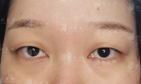 內(nèi)切去眼袋有手術(shù)風(fēng)險(xiǎn)嗎?做完需要多久才能恢復(fù)~