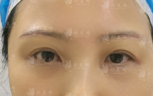 切眉手術(shù)怎么樣?什么人適合做切眉手術(shù)?
