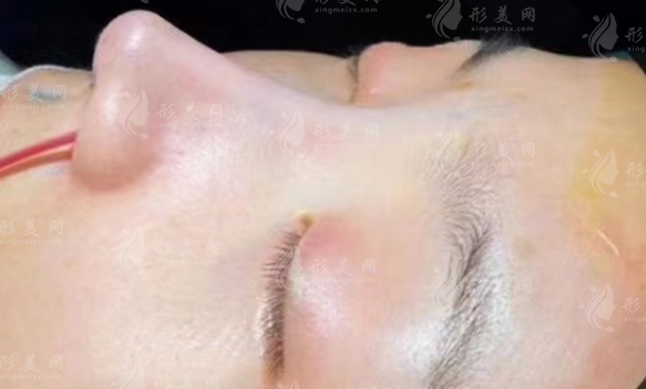 超肋骨隆鼻是什么材料?塑造自然小翹鼻~ 超肋骨隆鼻是什么材料?塑造自然小翹鼻~