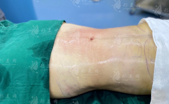 腰腹環(huán)吸多久可以上班，瘦的太理想了