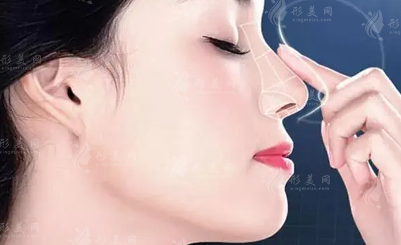 注射隆鼻好還是做假體好？?jī)?nèi)附手術(shù)介紹