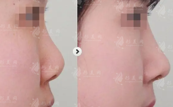 隆鼻用的假體需要更換嗎,可以用多少年? 隆鼻用的假體需要更換嗎,可以用多少年?