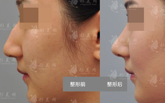 駝峰鼻矯正方法有哪些呢?效果怎么樣呢?