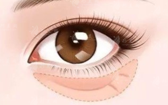 微創(chuàng)內(nèi)切去眼袋手術(shù)怎么樣？