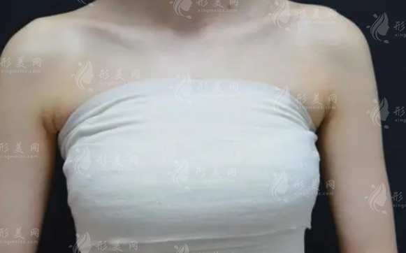 假體隆胸壽命有多久？失敗有什么表現(xiàn)？