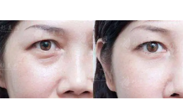 激光去眼袋效果好不好,做一次就有效果嗎?
