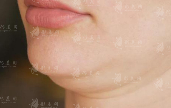 有雙下巴怎么辦，吸脂瘦雙下巴效果好不好呢？