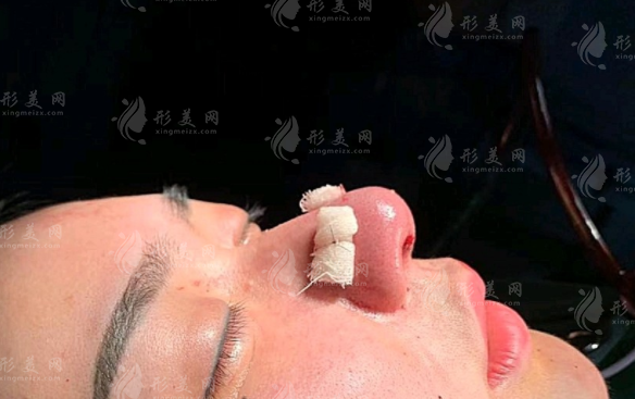 耳軟骨墊鼻梁的恢復期大概是多久呢？注意哪些能更快恢復？