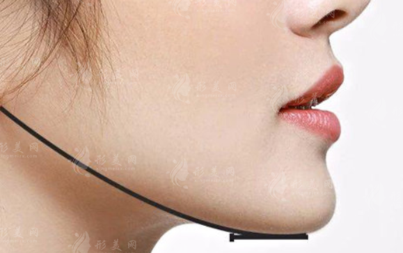 下頜骨整形風(fēng)險(xiǎn)是不是很大，怎么避免風(fēng)險(xiǎn)?