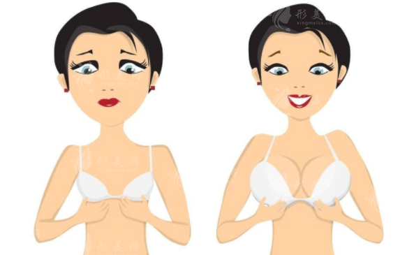 雙平面豐胸是什么?靠譜嗎?