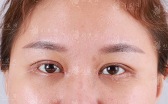 內(nèi)眥贅皮一定要矯正嗎？