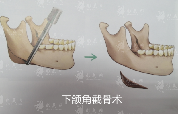 成都李運峰磨骨三件套價格，下頜角長曲線截骨口碑不錯，含價格表