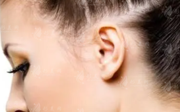 全耳再造手術(shù)費(fèi)用大概是多少? 全耳再造手術(shù)費(fèi)用大概是多少?