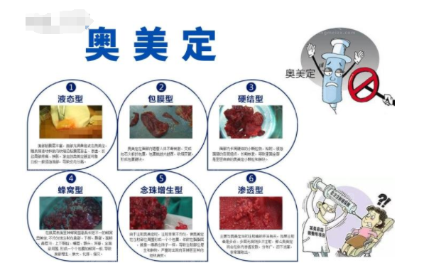 張本軍醫(yī)生取異物技術(shù)好嗎？上海整形價格費用全揭秘