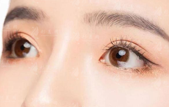 腫泡眼可以做雙眼皮手術(shù)嗎？需要注意什么？