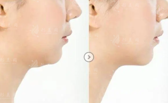 臉部吸脂價(jià)格受什么因素影響?