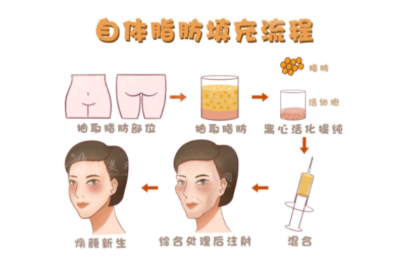 北京馮斌做脂肪填充好嗎？脂肪存活率高成功實(shí)例多，技術(shù)超級nice!