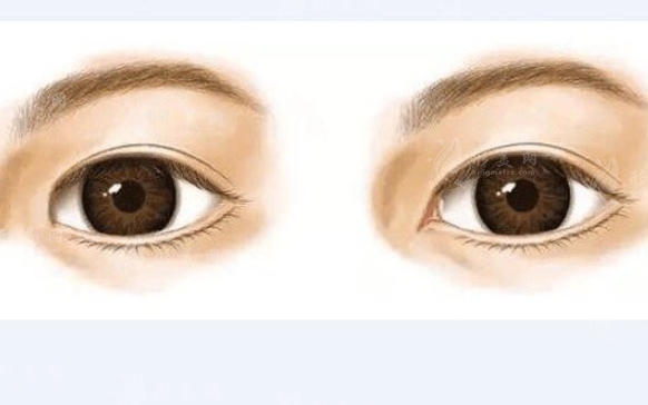 內(nèi)眥贅皮雙眼皮需要價(jià)錢是多少呢 影響的因素有哪些 內(nèi)眥贅皮雙眼皮需要價(jià)錢是多少呢 影響的因素有哪些