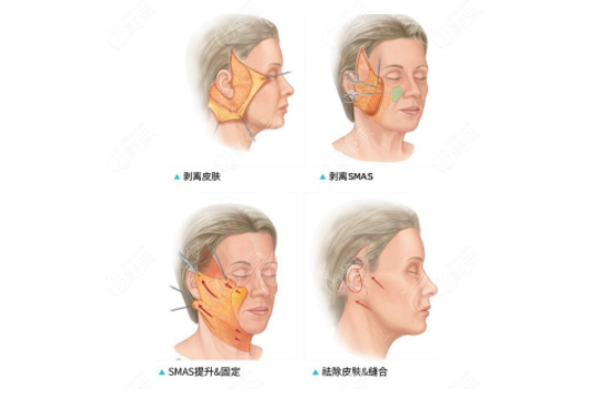 王志軍醫(yī)生做面部拉皮手術(shù)費用多少？