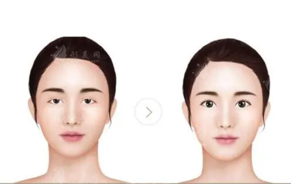 上瞼下垂矯正術(shù)的禁忌癥有哪些?