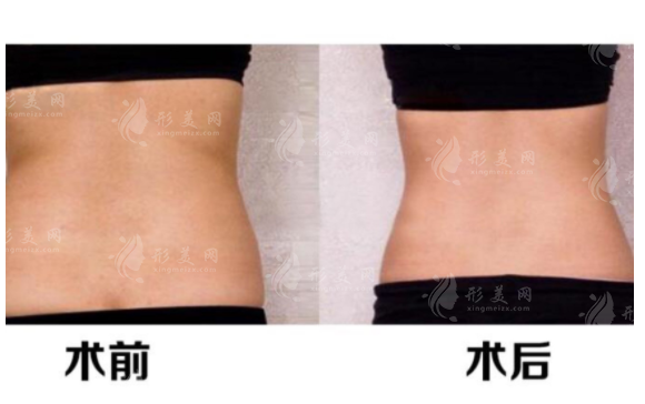 腰部共振吸脂有哪些注意事項(xiàng)？