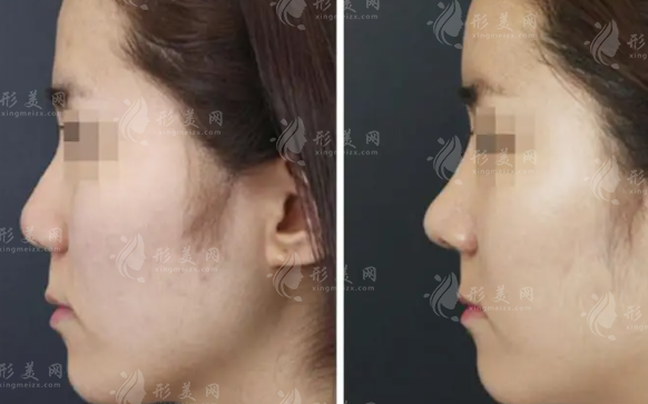 做假體隆鼻手術(shù)是不是很疼?怎么才不疼?