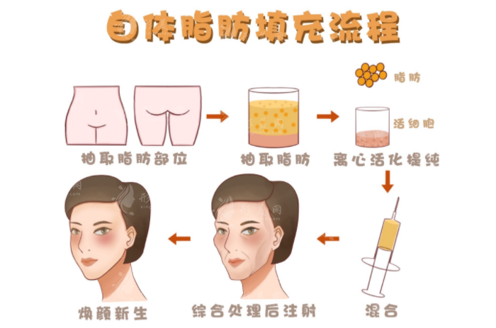 南京張讓虎做脂肪填充好嗎？