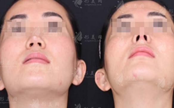 歪鼻整形的方式有哪些呢？當中哪個效果更好~
