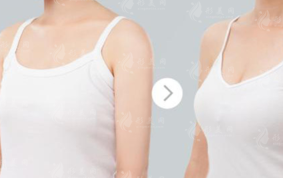 30歲女人應(yīng)該怎么隆胸比較好？看看哪個方式比較安逸~