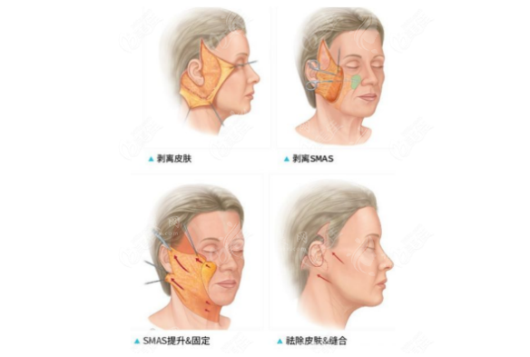 西安國際醫(yī)學(xué)王志軍預(yù)約掛號怎么約？高位SMAS除皺價格多少錢？