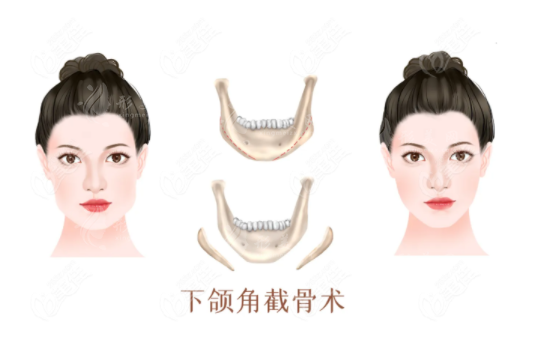 籍建華磨骨到底怎么樣？