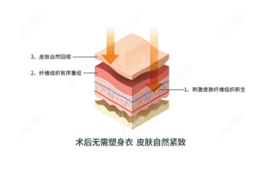 深圳曹孟君醫(yī)療美容價(jià)格表詳解：吸脂12800起，富貴包15800起