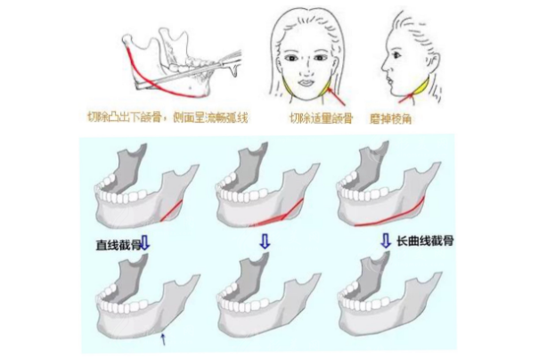 上海第九整形美容醫(yī)院下頜角磨骨/正頜手術(shù)/顴骨內(nèi)推手術(shù)價(jià)格