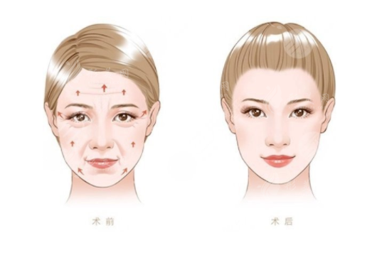 拉皮手術(shù)