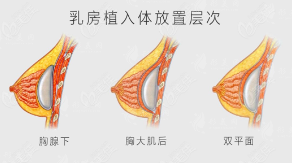 羅盛康隆胸技術好嗎？傲諾拉10w起/法芮婭15w起技術響當當