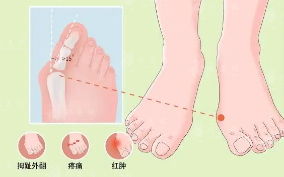 拇外翻手術(shù)