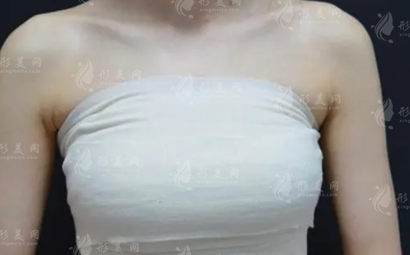 沈正宇醫(yī)生隆胸技術(shù)口碑全解析，內(nèi)窺鏡隆胸價格揭秘