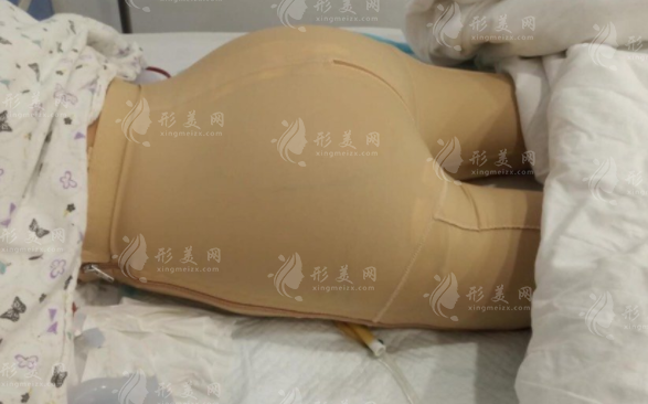 假體豐臀術(shù)后多久可以坐著?恢復(fù)時間、價格及后遺癥提前了解