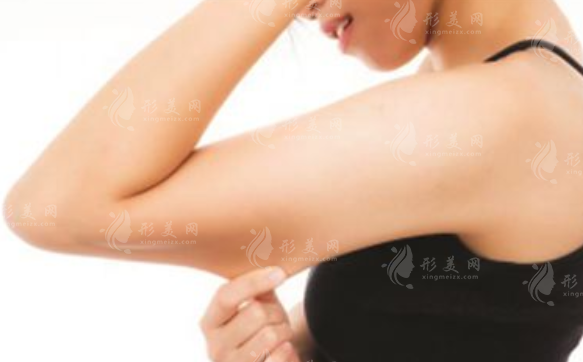 蝴蝶袖手臂吸脂：價(jià)格、保持時(shí)間與恢復(fù)期深度解析